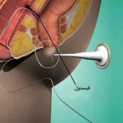 پکیج فیستول مقعدی