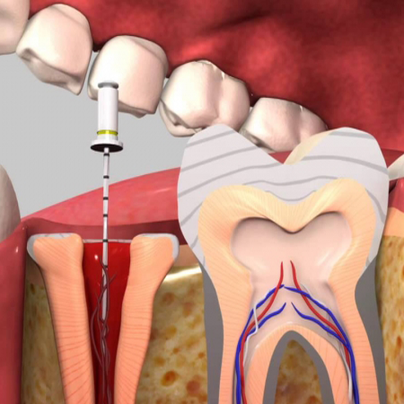 پکیج تخصصی درمان ريشه دو کانال